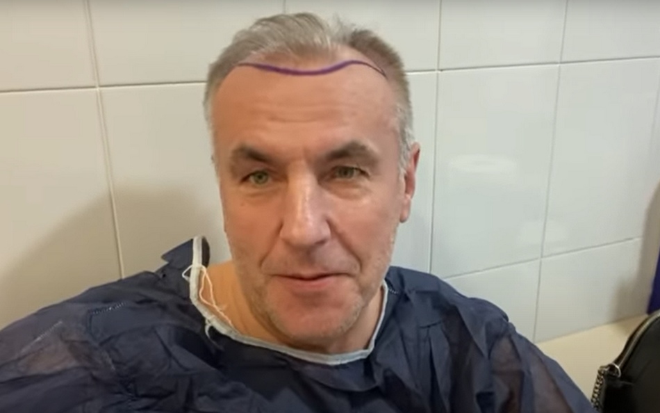 Брянский бизнесмен Александр Коломейцев сделал операцию по пересадке волос